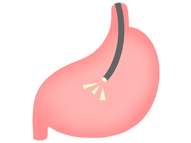 胃カメラ（胃内視鏡検査）