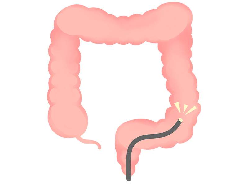 大腸カメラ（大腸内視鏡検査）